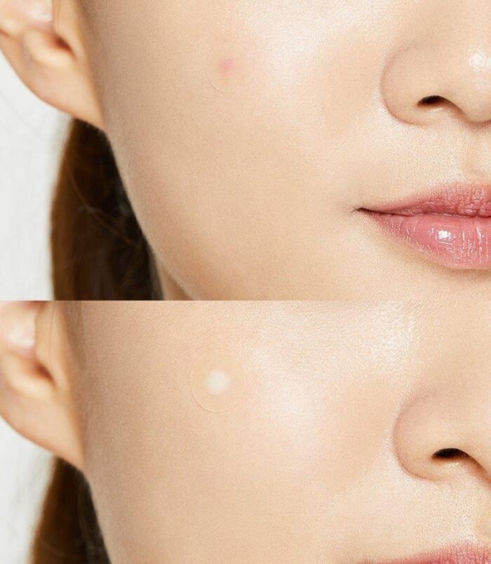acne-pimple-master-patch-cosrx-official-5.jpg